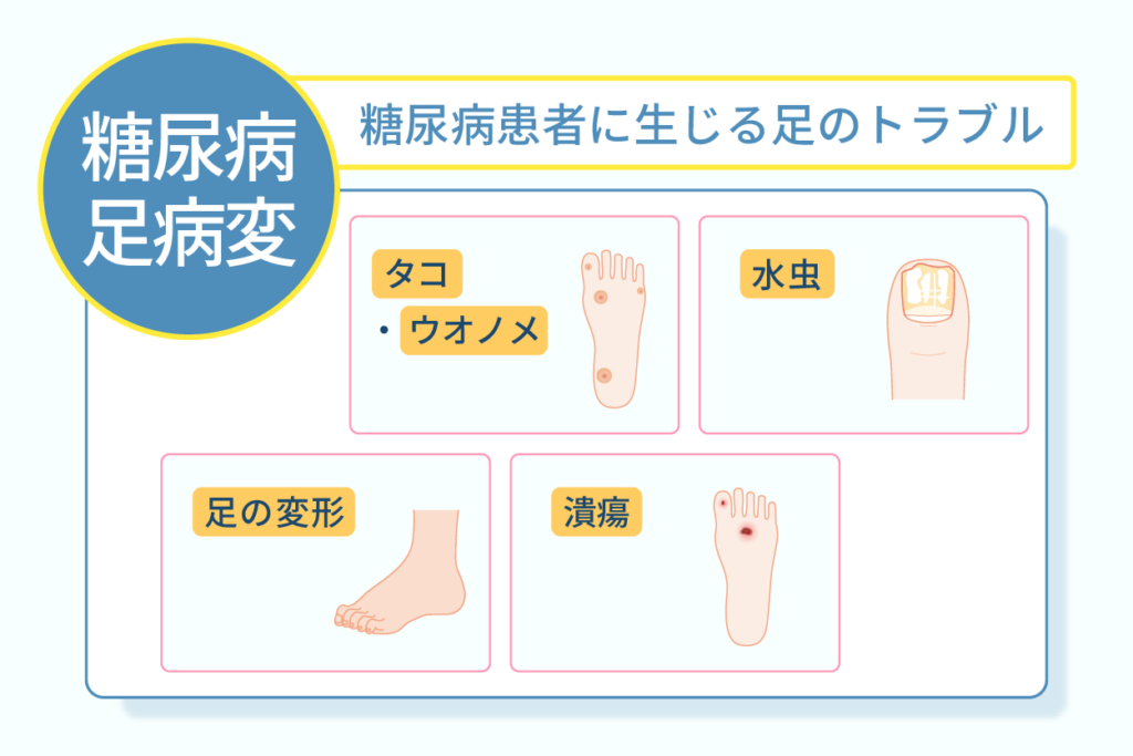 糖尿病患者に生じる足のトラブル