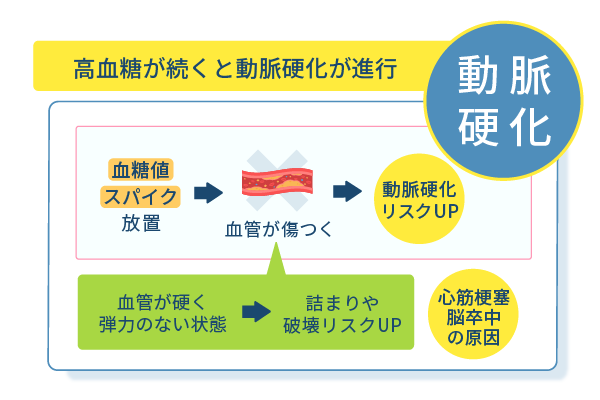 高血糖が続くと動脈硬化が進行